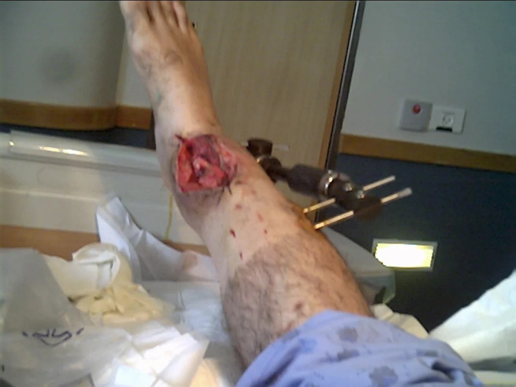 Broken Leg Fracture of the Distal Right Tibia with osteogenesis